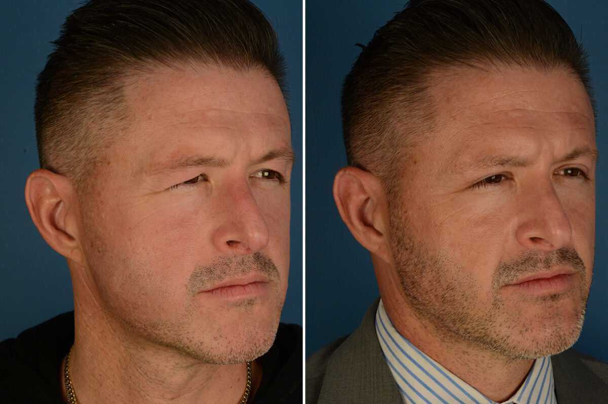 Blepharoplasty Before and After Photos in Naples, FL, Patient 34158