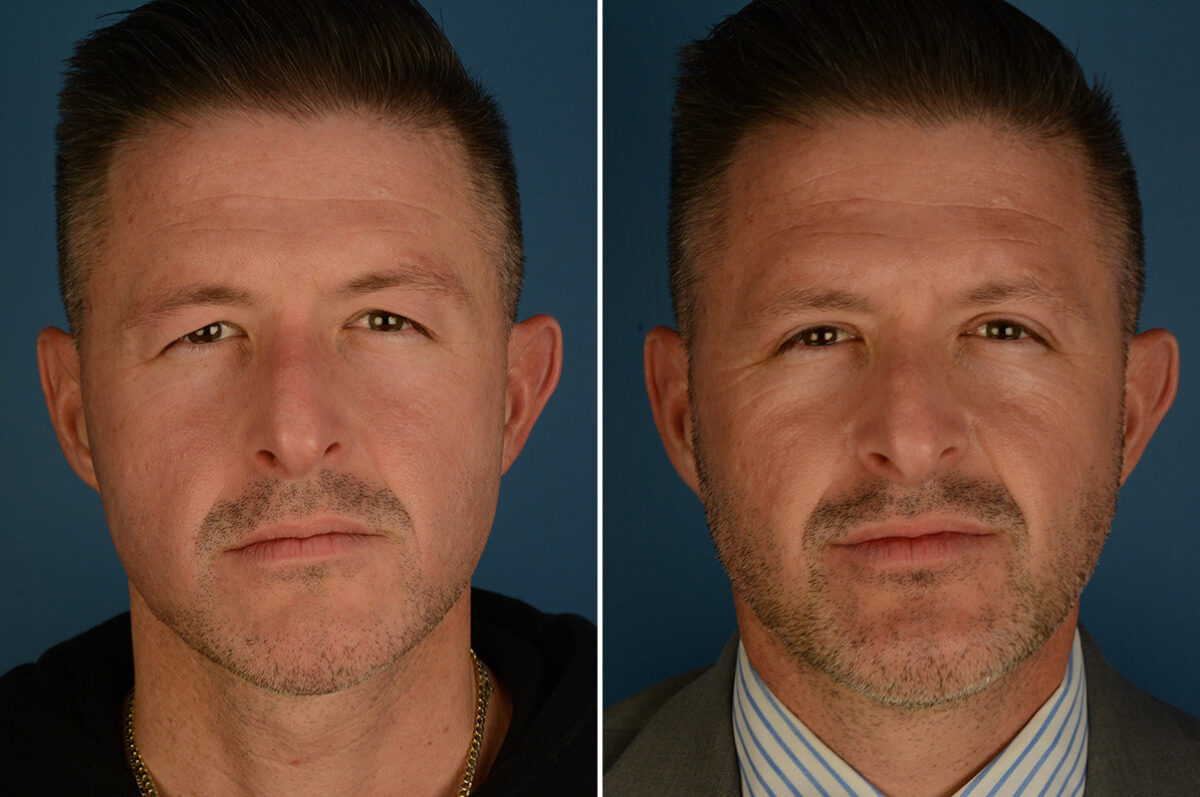 Blepharoplasty Before and After Photos in Naples, FL, Patient 34158