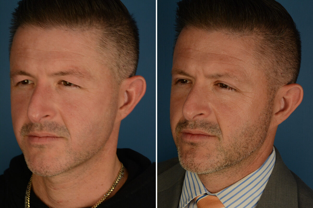 Blepharoplasty Before and After Photos in Naples, FL, Patient 34158