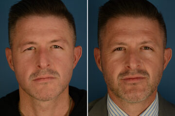 Blepharoplasty Before and After Photos in Naples, FL, Patient 34158