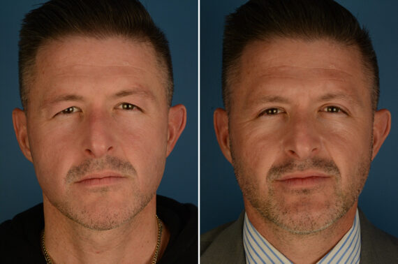Blepharoplasty Before and After Photos in Naples, FL, Patient 34158
