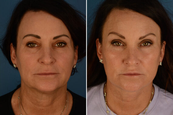 The UpLift™ Lower Face and Neck Lift Before and After Photos in Naples, FL, Patient 34294