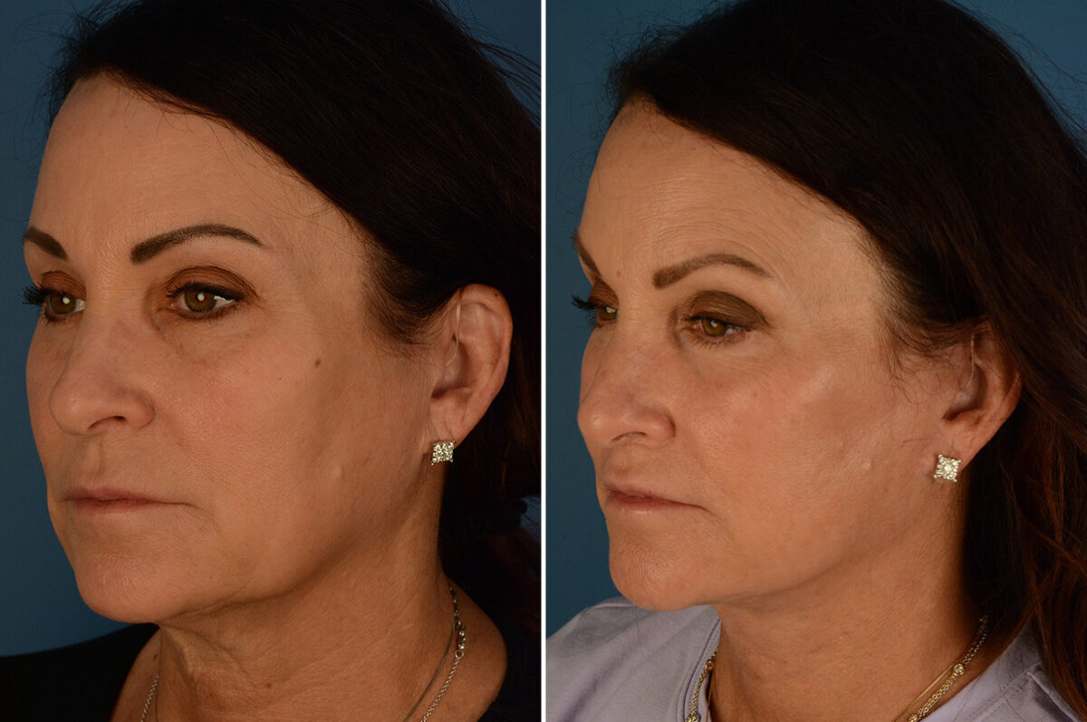 The UpLift™ Lower Face and Neck Lift Before and After Photos in Naples, FL, Patient 34294