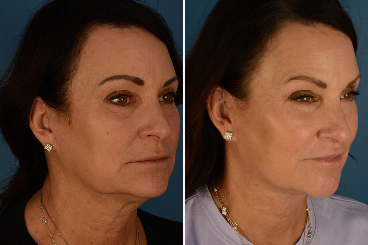 The UpLift™ Lower Face and Neck Lift Before and After Photos in Naples, FL, Patient 34294