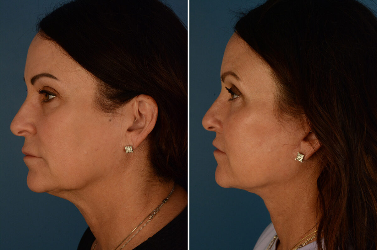 The UpLift™ Lower Face and Neck Lift Before and After Photos in Naples, FL, Patient 34294
