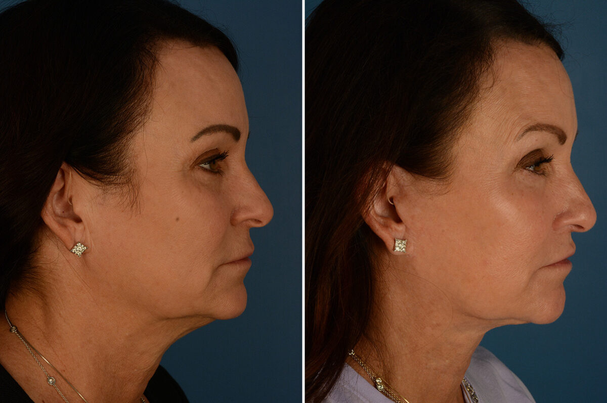 The UpLift™ Lower Face and Neck Lift Before and After Photos in Naples, FL, Patient 34294