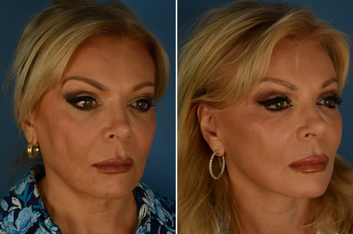 The UpLift™ Lower Face and Neck Lift Before and After Photos in Naples, FL, Patient 34338