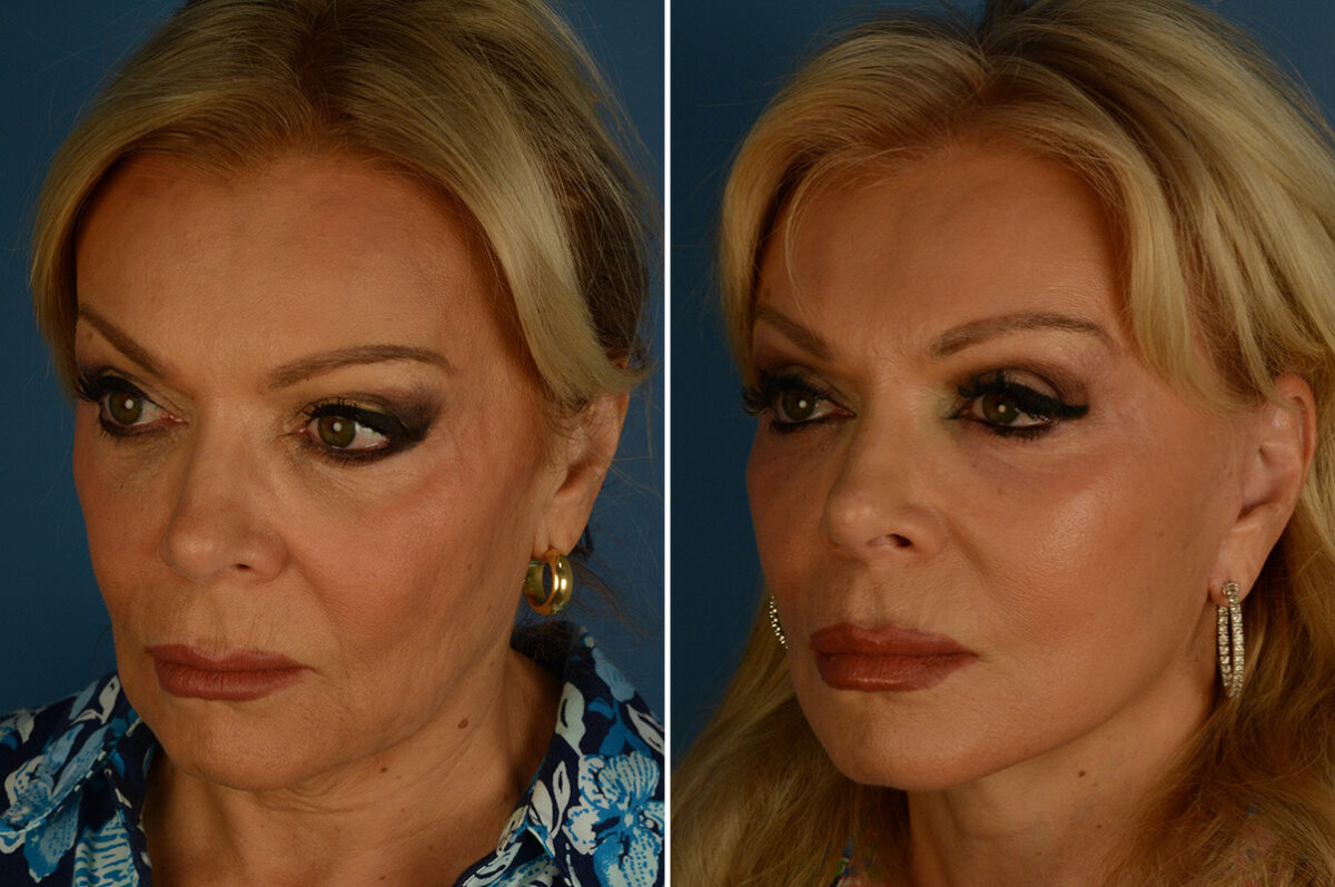 The UpLift™ Lower Face and Neck Lift Before and After Photos in Naples, FL, Patient 34338