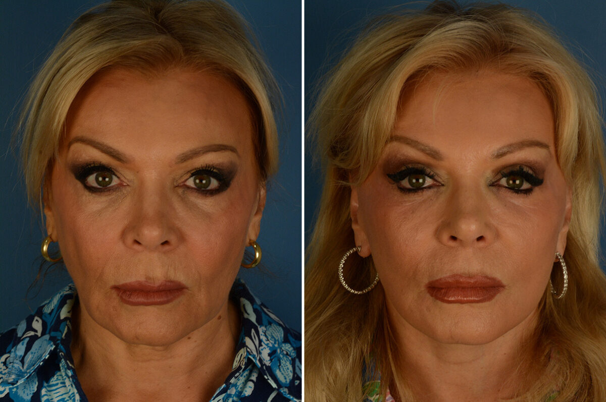 The UpLift™ Lower Face and Neck Lift Before and After Photos in Naples, FL, Patient 34338