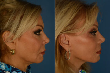 The UpLift™ Lower Face and Neck Lift Before and After Photos in Naples, FL, Patient 34338