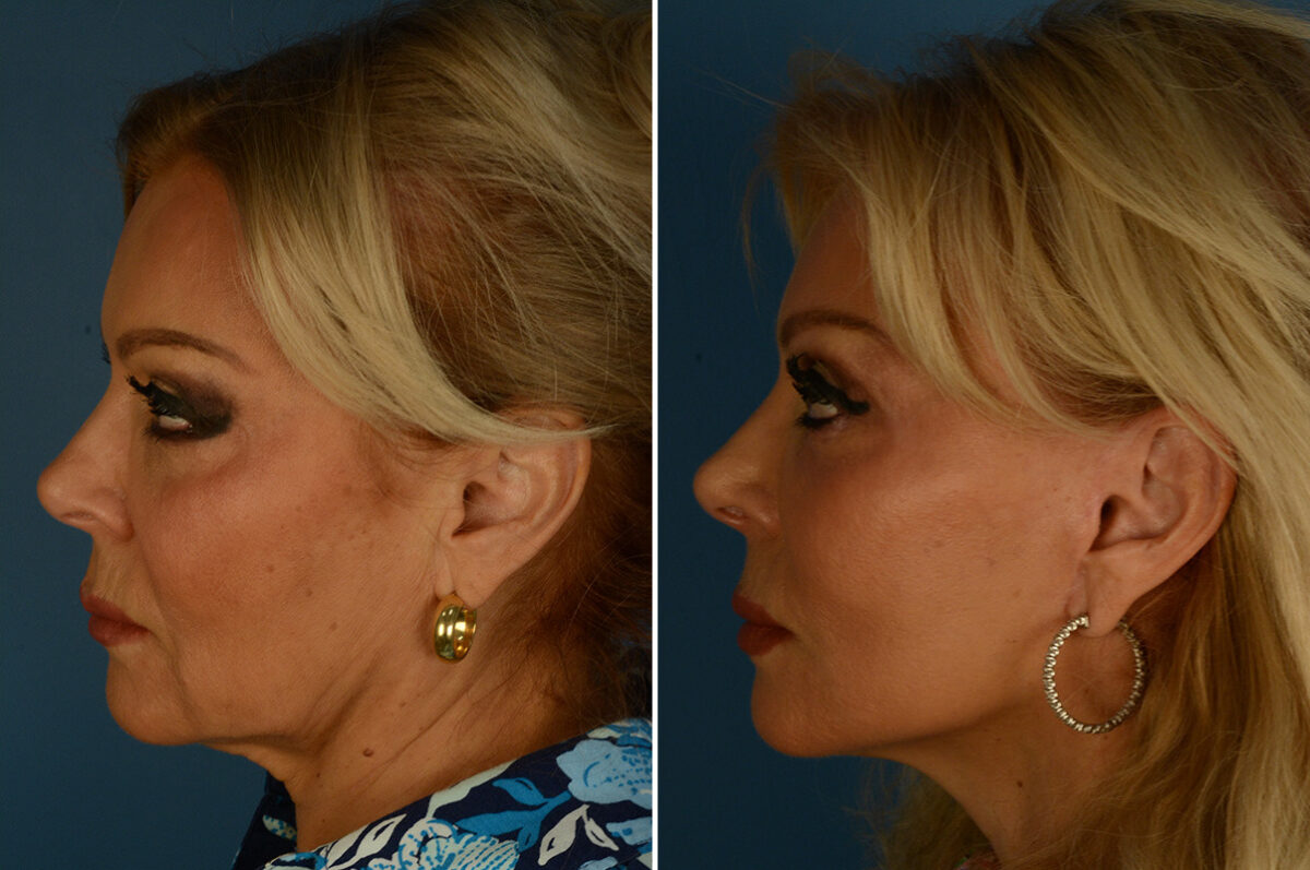 The UpLift™ Lower Face and Neck Lift Before and After Photos in Naples, FL, Patient 34338